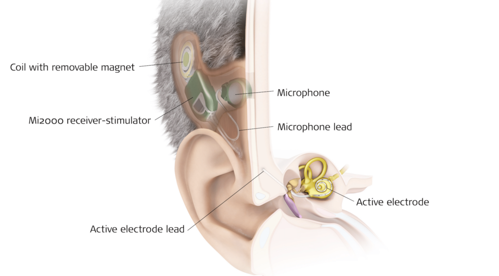 Des résultats prometteurs pour l’implant cochléaire totalement implantable (TICI) de MED-EL